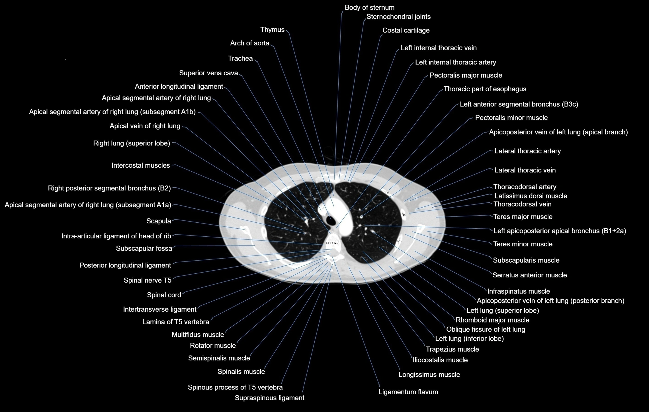 CT chest (thorax) labelled axial cross sectional anatomy radiology image-00037.webp